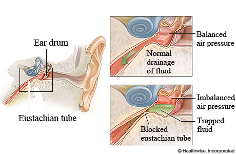 Eustachian Tube Dysfunction